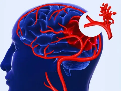 Nguyên nhân gây đột quỵ không triệu chứng, bác sĩ chỉ cách nhận biết
