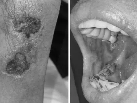 Uống sai liều thuốc da liễu, nhiều người ngộ độc nặng