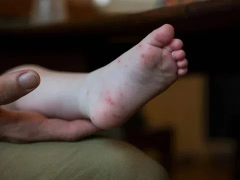 Vì sao trẻ mắc tay chân miệng nhiều lần?