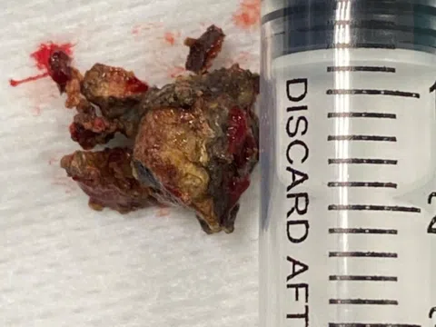 Bác sĩ gắp dị vật khó tin, chiếm toàn bộ hốc mũi chàng trai 34 tuổi