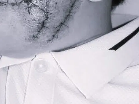 Bé 5 tuổi thương tích nặng sau khi bị chó nuôi tấn công