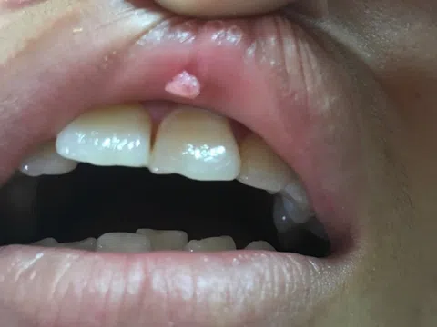 Cô gái 23 tuổi mắc sùi mào gà ở miệng