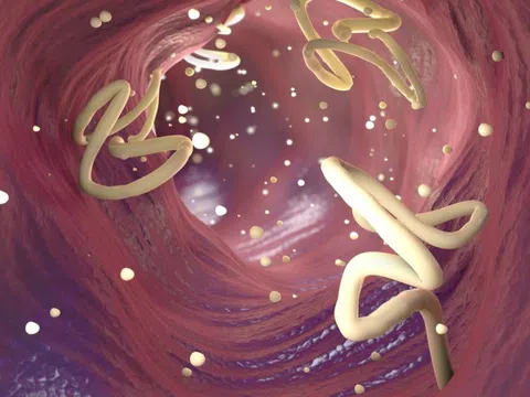 Nguy cơ sán vào não từ thói quen ăn uống, bác sĩ chỉ cách phòng tránh