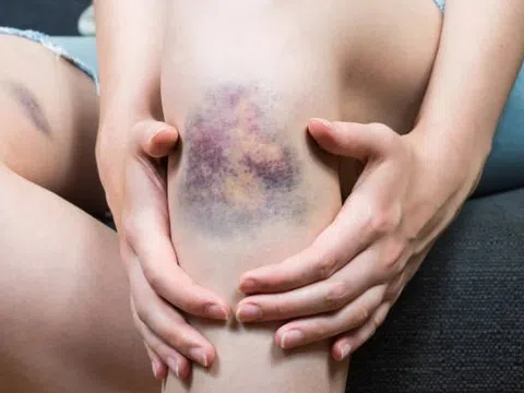 Dấu hiệu cơ thể cảnh báo nóng gan