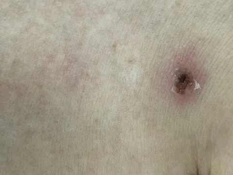 Đừng coi thường vết loét tròn màu đen ở các hõm cơ thể