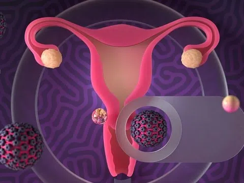 Các yếu tố làm tăng nguy cơ nhiễm HPV gây ung thư