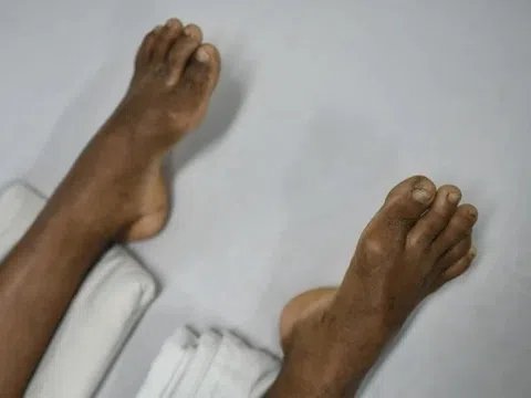 Thập tử nhất sinh chỉ vì chủ quan với chiếc răng sâu