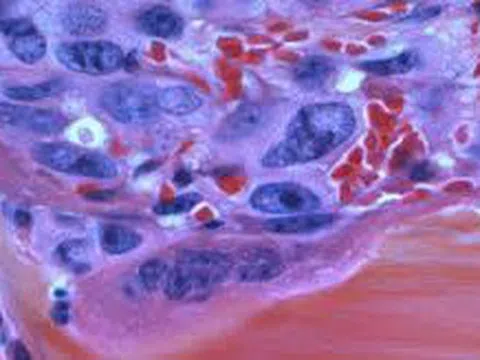 Làm rõ tin đồn 'khối u là túi độc tố và sinh thiết khiến độc tố phát tán'