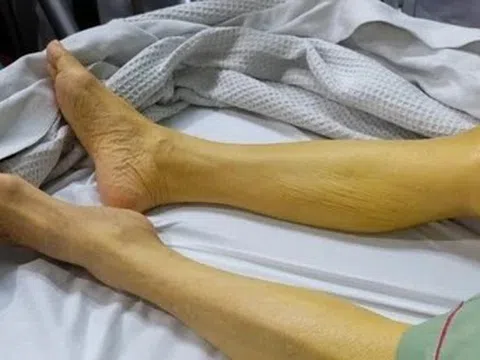 Vì sao người Việt dễ mắc ung thư gan?