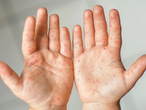 Triệu chứng bệnh tay chân miệng theo từng giai đoạn
