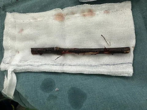 Cành cây 16 cm trong bụng bé 3 tuổi suốt 4 tháng không hay biết