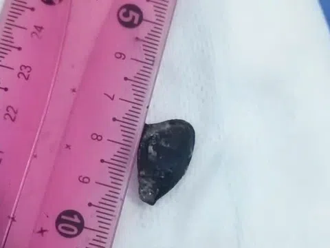 Hạt sapo bị bỏ quên 10 năm trong lòng phế quản