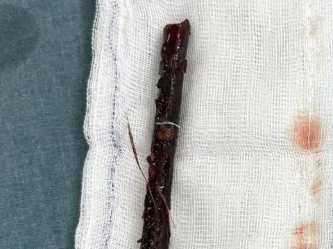 Bé gái 3 tuổi mang cành cây dài 16cm trong bụng suốt 4 tháng