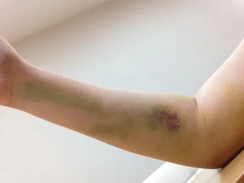 Một phòng bệnh có 3 cặp vợ chồng cùng điều trị ung thư