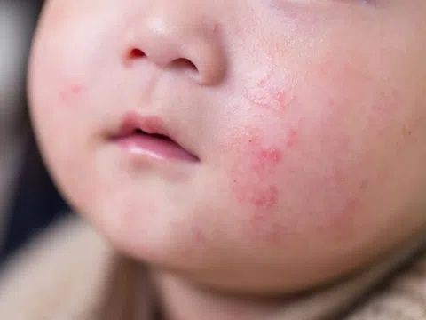 Dấu hiệu cảnh báo trẻ bị dị ứng sữa bò cha mẹ cần biết
