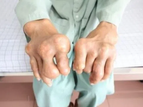 Đôi bàn tay gây ám ảnh của người đàn ông chủ quan với bệnh