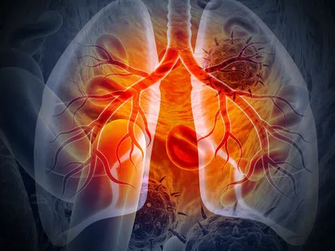 9 dấu hiệu cảnh báo sớm của bệnh ung thư phổi