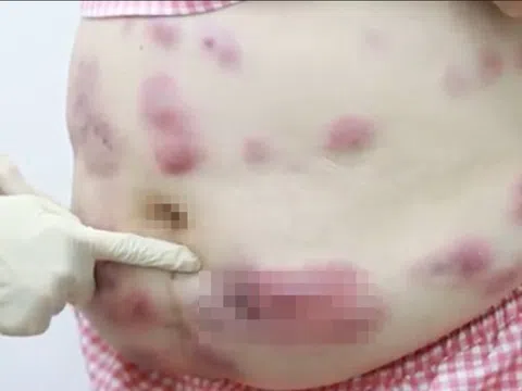 Hình ảnh gây sốc sau khi một phụ nữ ở TP.HCM tiêm tan mỡ