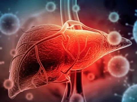 Triệu chứng sớm của bệnh viêm gan A