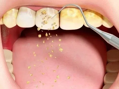 Điều gì xảy ra khi không lấy vôi răng?