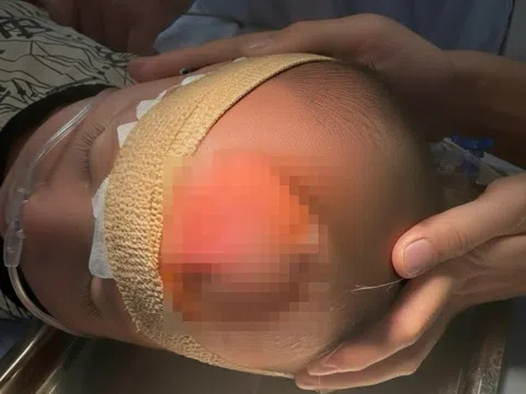 Từ nốt mẩn nhỏ đến áp xe trán, bác sĩ chỉ ra sai lầm thường gặp