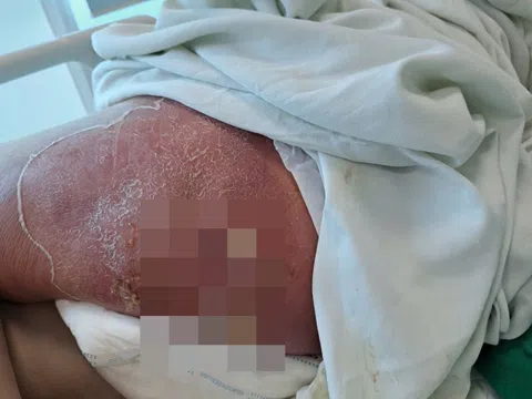 Vết mụn tưởng nhỏ ở mông biến thành cơn bạo bệnh