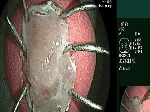 Bất thường khi đại tiện, đi khám phát hiện mắc hai loại ung thư