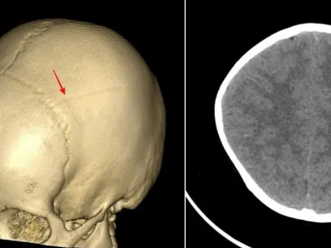 Cha mẹ hối hận vì cú ngã tưởng chừng vô hại của con