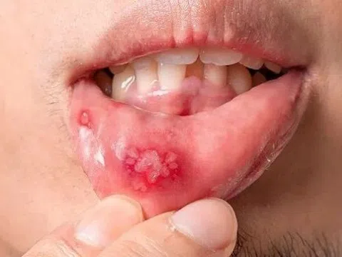 Vết thương hở và nguy cơ lây truyền HIV