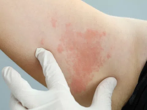 Biểu hiện tưởng bình thường nhưng có thể là dấu hiệu sớm của HIV