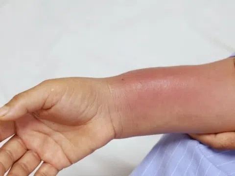 Gánh hậu quả nặng nề vì một sai lầm nhiều người làm khi đau