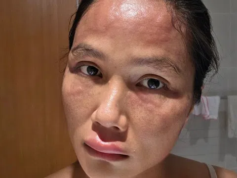 Triệu chứng Hoa hậu H’Hen Niê mắc sau sinh