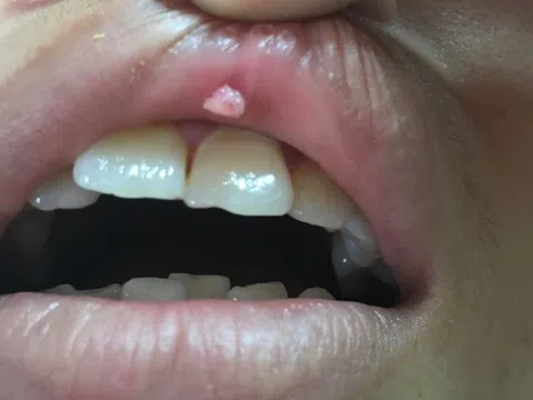 Dấu hiệu của sùi mào gà giai đoạn đầu