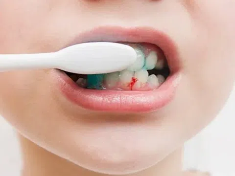 Vì sao bị chảy máu chân răng?