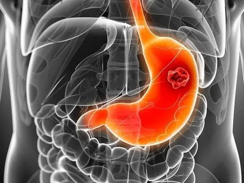 Bác sĩ chỉ cách ăn uống ngừa ung thư dạ dày