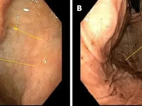 Ung thư gan phát triển thần tốc sau 1 năm phát hiện viêm gan B