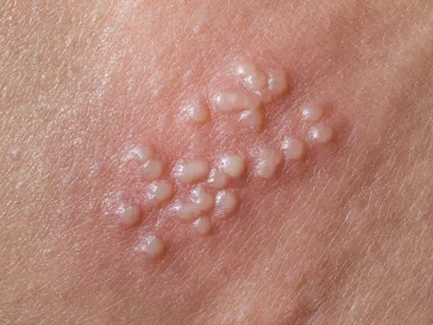 Nguyên nhân gây bệnh mụn rộp sinh dục