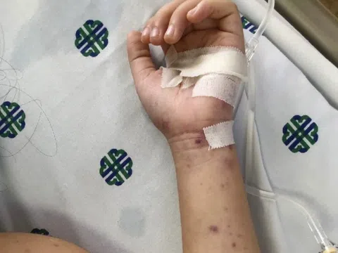 Bệnh não mô cầu tăng 6 lần, người khỏe mạnh có thể tử vong trong 24 giờ