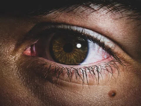 Nốt ruồi có dấu hiệu lạ, người đàn ông đi khám phát hiện ung thư