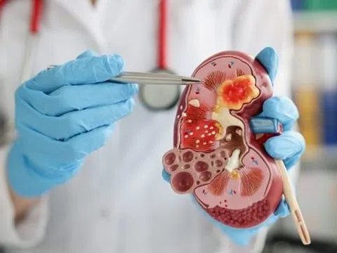 4 dấu hiệu ở nước tiểu cho thấy thận đang có vấn đề