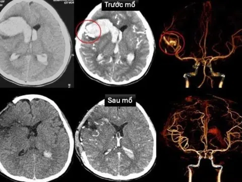 Bé gái TP.HCM vỡ mạch máu não, sốc tim nguy kịch khi đang ngủ