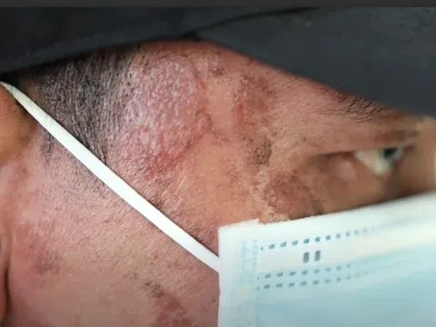 Người dân TP.HCM khổ sở vì kiến ba khoang