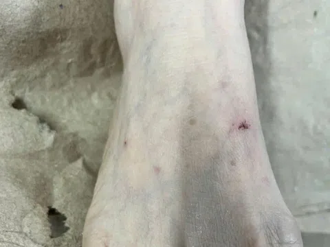 Gánh hậu quả vì nặn máu, thoa nước chanh lên vết mèo cắn