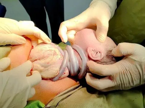 Em bé chào đời với 6 vòng dây rốn quấn quanh cổ