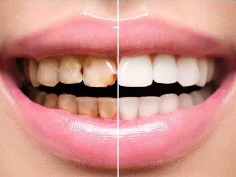 Khi nào không nên lấy cao răng?