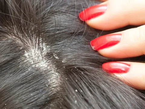 Nhập viện khẩn cấp sau khi ủ tóc diệt chấy