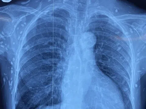 6 loại ký sinh trùng gây nguy hiểm ở người