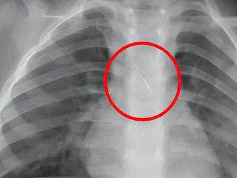 Kim chọc tủy dài 22mm rơi vào đường thở bé trai 3 tuổi khi làm răng