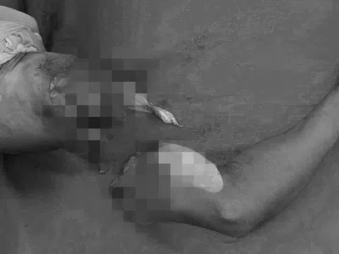 Người đàn ông nhập viện với cánh tay đứt lìa
