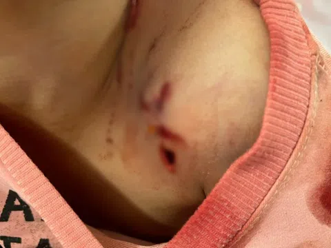 Bé 6 tuổi chấn thương nghiêm trọng do chó nhà 20 kg tấn công